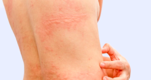 La piel, el órgano más grande de nuestro cuerpo, requiere cuidado permanente