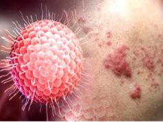 Herpes zóster y los mitos más comunes sobre esta enfermedad