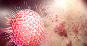 Herpes zóster y los mitos más comunes sobre esta enfermedad
