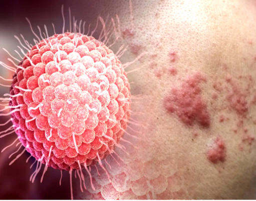 Herpes zóster y los mitos más comunes sobre esta enfermedad